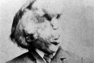 Elephant Man, l'histoire tragique de Joseph Merrick  Marseille